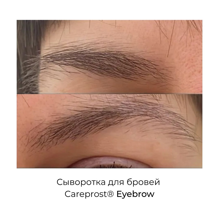 Careprost для роста бровей. Процедура для роста бровей.